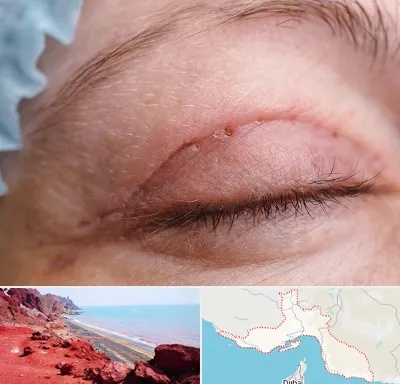 جراح پلک در هرمزگان
