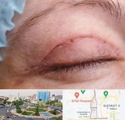 جراح پلک در ونک 