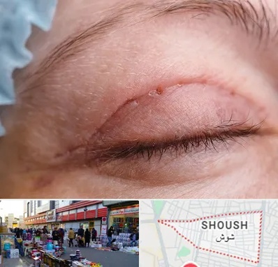 جراح پلک در شوش