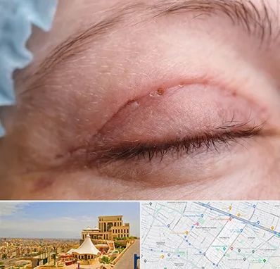 جراح پلک در هاشمیه مشهد