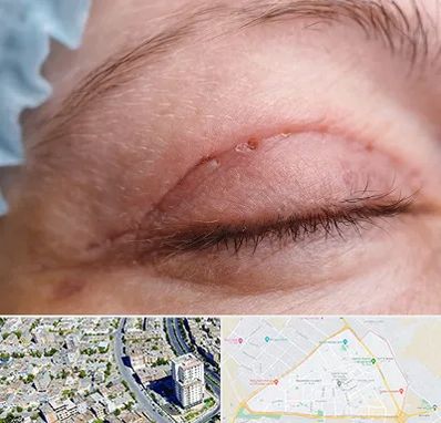 جراح پلک در قاسم آباد مشهد 