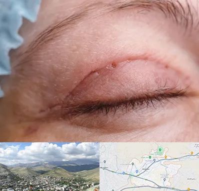 جراح پلک در رودهن