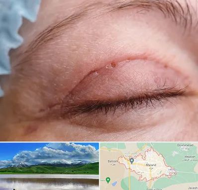 جراح پلک در مرند