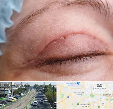 جراح پلک در جنوب تهران 