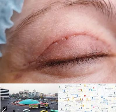 جراح پلک در میدان انقلاب 