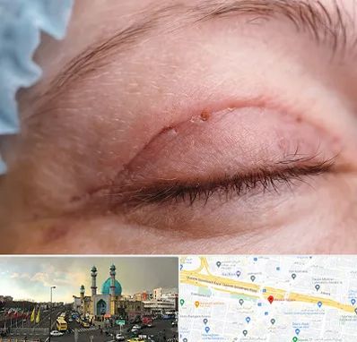 جراح پلک در رسالت 