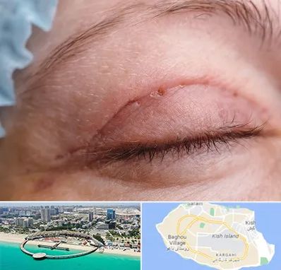 جراح پلک در کیش