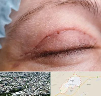 جراح پلک در شاهرود