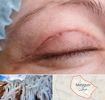 جراح پلک در میگون