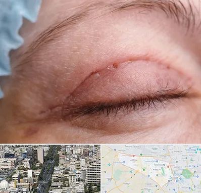 جراح پلک در منطقه 18 تهران 