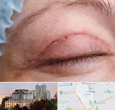 جراح پلک در فرشته 