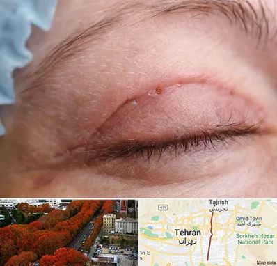 جراح پلک در ولیعصر 