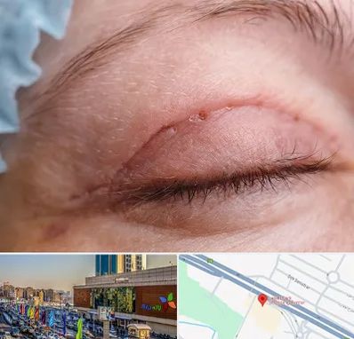 جراح پلک در لاله پارک تبریز