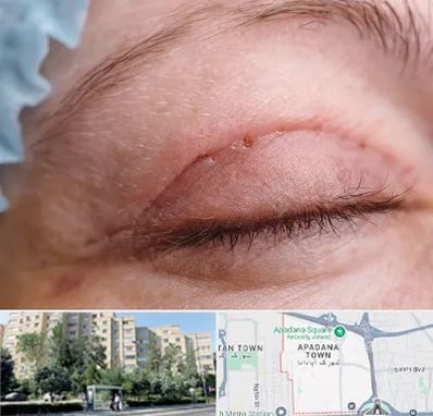 جراح پلک در آپادانا