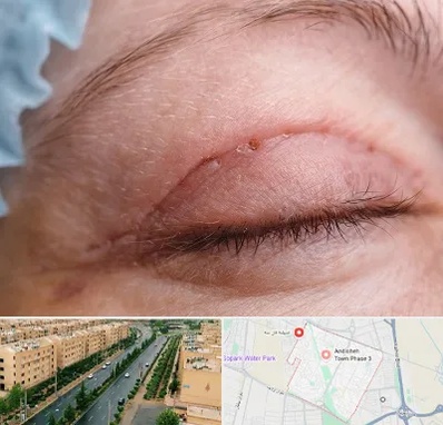 جراح پلک در فاز سه اندیشه