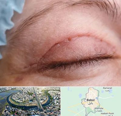 جراح پلک در بابل