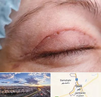 جراح پلک در قم
