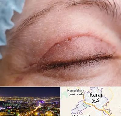 جراح پلک در کرج