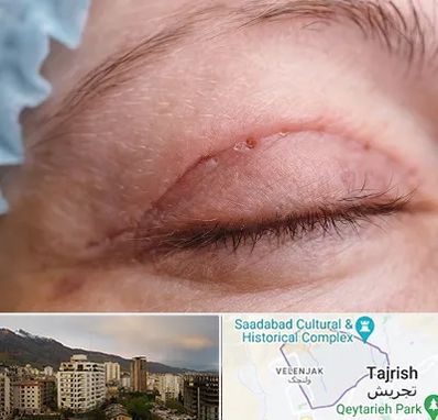 جراح پلک در زعفرانیه 