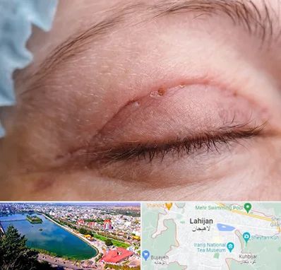 جراح پلک در لاهیجان