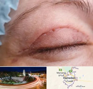 جراح پلک در همدان
