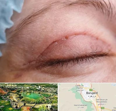 جراح پلک در بروجرد