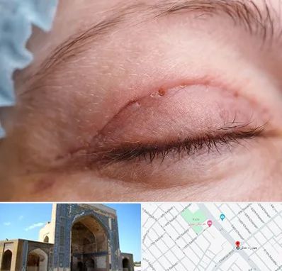 جراح پلک در مصلی مشهد