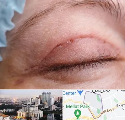 جراح پلک در الهیه 