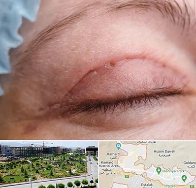 جراح پلک در پردیس