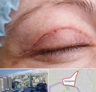جراح پلک در محمودیه