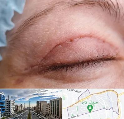 جراح پلک در سعادت آباد 