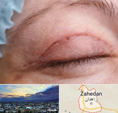 جراح پلک در زاهدان