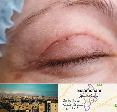 جراح پلک در اسلامشهر