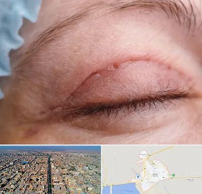 جراح پلک در بندر ماهشهر