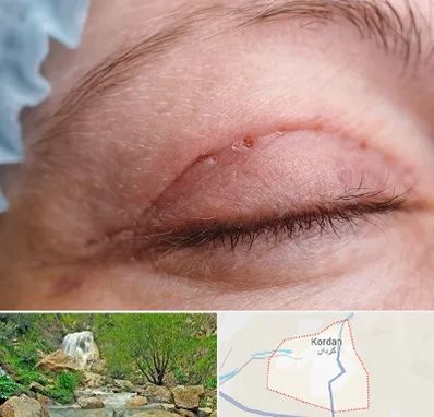 جراح پلک در کردان
