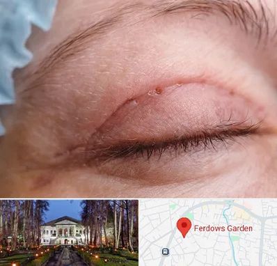 جراح پلک در باغ فردوس