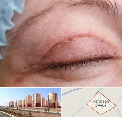 جراح پلک در پردیسان قم