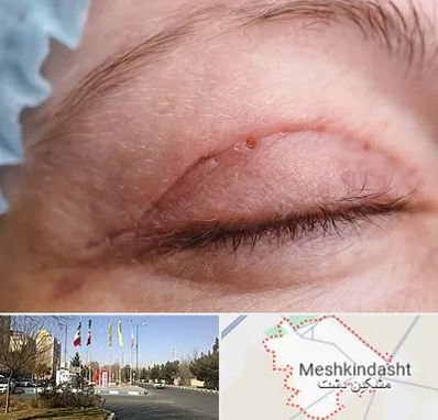 جراح پلک در مشکین دشت