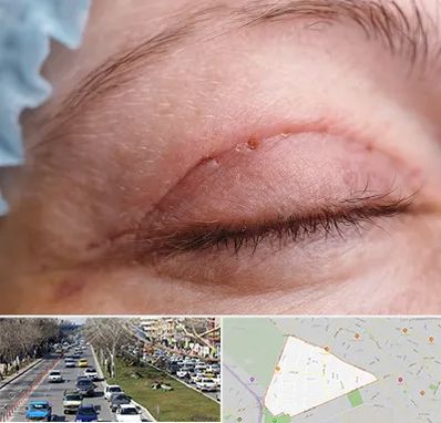 جراح پلک در احمدآباد مشهد 