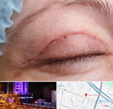 جراح پلک در آبرسان تبریز