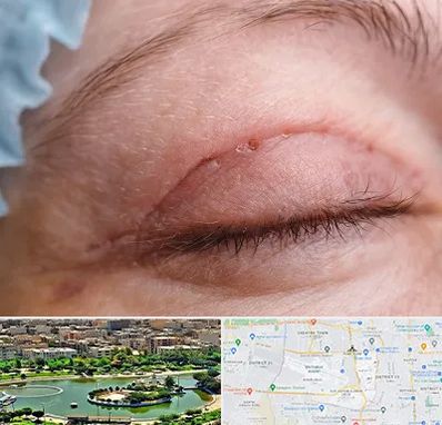 جراح پلک در منطقه 9 تهران 