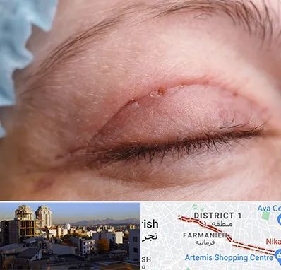 جراح پلک در فرمانیه 