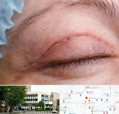 جراح پلک در طالقانی 