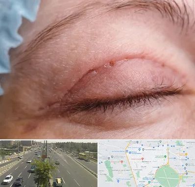 جراح پلک در منطقه 17 تهران 