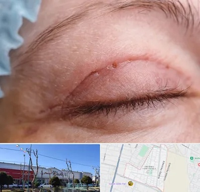 جراح پلک در فاز دو اندیشه