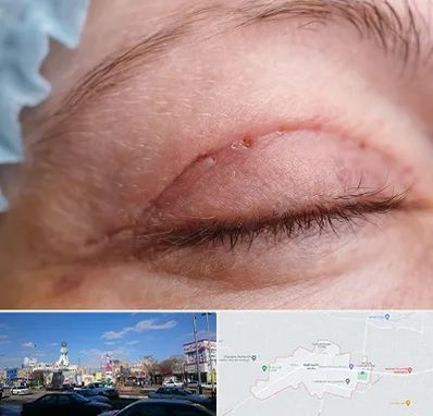 جراح پلک در ماهدشت کرج 