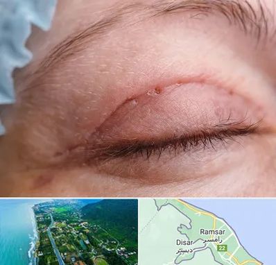 جراح پلک در رامسر