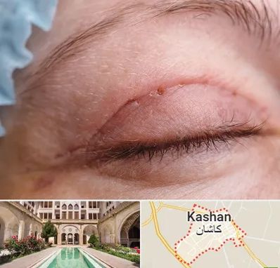جراح پلک در کاشان