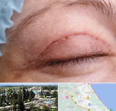 جراح پلک در رودسر