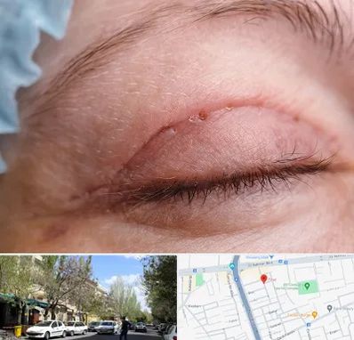 جراح پلک در کوی فیروز تبریز